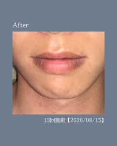 00AD8C04 5EBF 4972 B3AF 4F2F59FF6397 ひげ脱毛の変化！沖縄メンズ脱毛