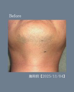ひげ脱毛before after!沖縄メンズ脱毛 2 1CFAF621 E696 4FFC 8C30 555C72B79C20 ひげ脱毛before after!沖縄メンズ脱毛