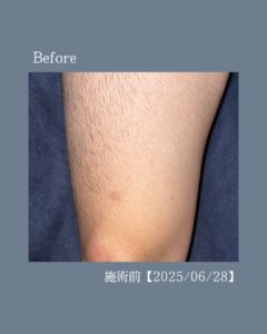 足脱毛6回の変化!沖縄メンズ脱毛 2 1DAAE162 2897 496C 987C 3EE120F70E5C 足脱毛6回の変化!沖縄メンズ脱毛