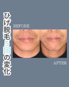 ひげ脱毛5回の変化!沖縄メンズ脱毛 1 270AADD5 4AC8 4A0E 8FC9 D24257DD49D4 ひげ脱毛5回の変化!沖縄メンズ脱毛