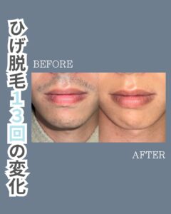35637D08 9C89 4CA3 8F6F A82D32DA476C ひげ脱毛の変化！沖縄メンズ脱毛