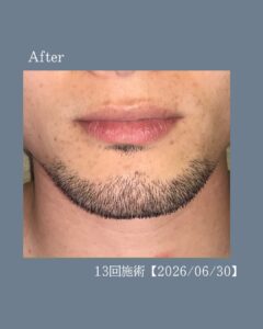 デザインひげもキレイ!沖縄メンズ脱毛 3 57AD96C2 17F0 4AE6 8F1E 3E0C9ECA61CC デザインひげもキレイ!沖縄メンズ脱毛