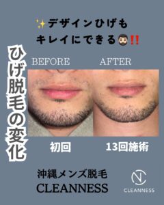デザインひげもキレイ!沖縄メンズ脱毛 1 62FCFC58 C423 47DB B89A 65F1D93A2DAF デザインひげもキレイ!沖縄メンズ脱毛