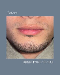 デザインひげもキレイ!沖縄メンズ脱毛 2 798647DD 848A 4C87 A74C A20920165B97 デザインひげもキレイ!沖縄メンズ脱毛