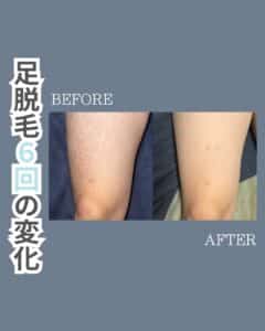 足脱毛6回の変化!沖縄メンズ脱毛 1 7D109BE2 AFD8 496D B8F4 B9C1D4465F9B 足脱毛6回の変化!沖縄メンズ脱毛