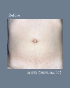 BC7E5B8C BC46 4716 84CB 8DC7288D79EB お腹脱毛の変化！沖縄メンズ脱毛