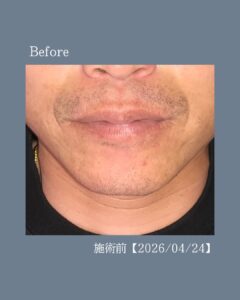 ひげ脱毛5回の変化!沖縄メンズ脱毛 2 CF0DF431 36C1 4201 963B 44A8C353EAF3 ひげ脱毛5回の変化!沖縄メンズ脱毛