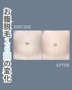 D675268A 940F 4BFB BA75 4ED093E39C55 お腹脱毛の変化！沖縄メンズ脱毛