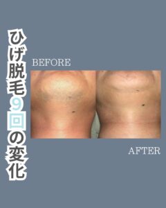 ひげ脱毛before after!沖縄メンズ脱毛 1 DF678F56 1AE9 4274 8E72 D6F0166FF0B0 ひげ脱毛before after!沖縄メンズ脱毛