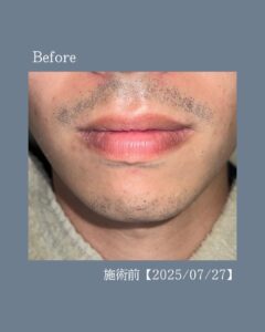 EFCAAB24 FFA5 467B AA51 3F771AB81DBB ひげ脱毛の変化！沖縄メンズ脱毛