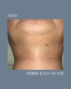 ひげ脱毛before after!沖縄メンズ脱毛 3 F1FCE3E2 F53E 4DD1 A8F3 180D759D0BB5 ひげ脱毛before after!沖縄メンズ脱毛