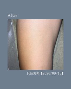 0927A62B EC07 466A 940E A4B3F7E54EFB あし脱毛16回の変化！沖縄メンズ脱毛