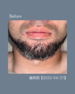2F8F83F1 F58E 4D3D 9461 4EE0F002BBD9 キレイに整うデザインひげ！沖縄メンズ脱毛
