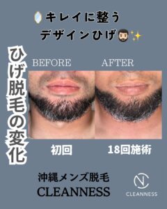 3C5FAD93 4F3A 4B4F 9319 91345AA13E3F キレイに整うデザインひげ！沖縄メンズ脱毛