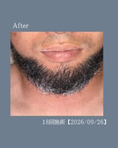 3C777990 388A 471B 9F5A 3D4646B36325 キレイに整うデザインひげ！沖縄メンズ脱毛