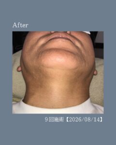 49AF931D 18A2 4E5B 85D7 7FF4358D0EC5 ひげ脱毛９回の変化！沖縄メンズ脱毛