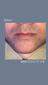 4ABDD444 A2F2 467B AFFF 8D08439ED49E デザインひげbefore→after！沖縄メンズ脱毛
