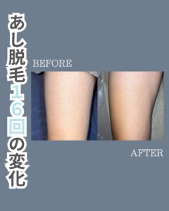 4E9BB923 DAC2 4BF7 A313 98150807BEAF あし脱毛16回の変化！沖縄メンズ脱毛