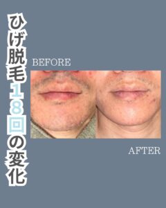 7191AFDE 31AD 43A7 B74C 50156EAB7495 脱毛で肌キレイへ！？沖縄メンズ脱毛