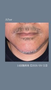 83C7BCCB D3FE 4302 A5B9 92081AB15006 デザインひげbefore→after！沖縄メンズ脱毛