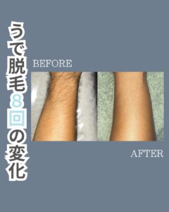 A5EF1FF2 B082 4FD0 B0FB 947A11CC26E5 うで脱毛8回の変化！沖縄メンズ脱毛