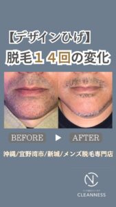 F56FC43E B3EB 4E38 B263 3D7989B84DEA デザインひげbefore→after！沖縄メンズ脱毛