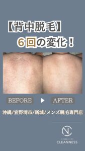 24A79823 F6BC 402F B2AC 3C29C5005258 背中脱毛6回の変化！沖縄メンズ脱毛