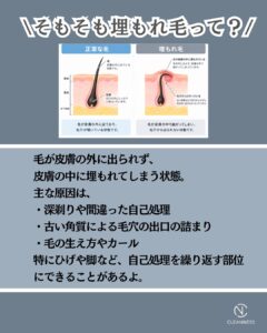 313DE564 2EBC 4C11 9669 40AC9A7000DA 知らないと損する脱毛の豆知識！沖縄メンズ脱毛