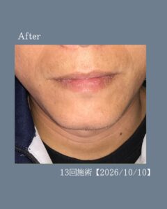6DD4F04C EC00 4918 A395 D62C4ED0CAD8 ひげ脱毛13回の変化！沖縄メンズ脱毛