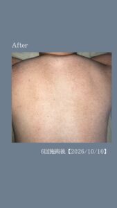 9D543626 E310 4027 B399 015DC7930739 背中脱毛6回の変化！沖縄メンズ脱毛