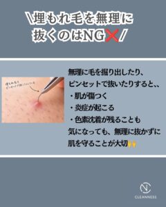 CF8B711D 50BC 42C6 896A 6D57CC19C79D 知らないと損する脱毛の豆知識！沖縄メンズ脱毛